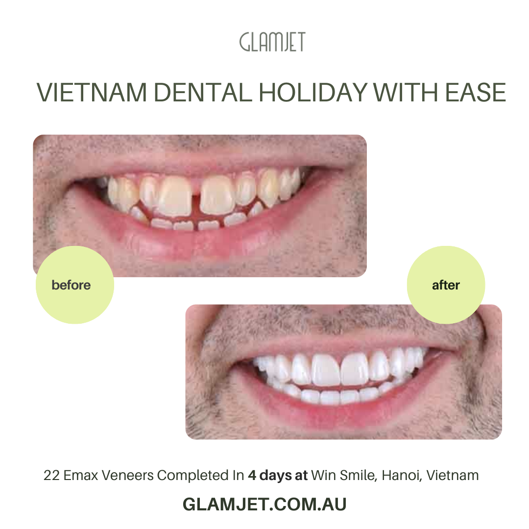 Dramatic before and after results of Emax Ceramic Veneers (no prep) performed at Win Smile Dental Clinic in Hanoi. Win smile is a top rated dental clinic in Vietnam with dentists with many years of experiences.  Glamjet Dental Holiday specialises in combining world-class dental care with memorable Vietnam travel experiences for many clients in Australia, New Zealand, and the USA. 