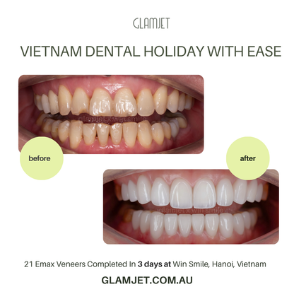Experience life-changing results with Emax Ceramic Veneers at Win Smile Dental Clinic, Hanoi. Glamjet Dental Holiday simplifies dental tourism, offering access to Vietnam’s best dentists and vibrant travel destinations. Emax Ceramic Veneers are superior than porcelain veneers. Clients have bright white teeth instead of yellow teeth. No prep veneers or minimal prep veneers are available.