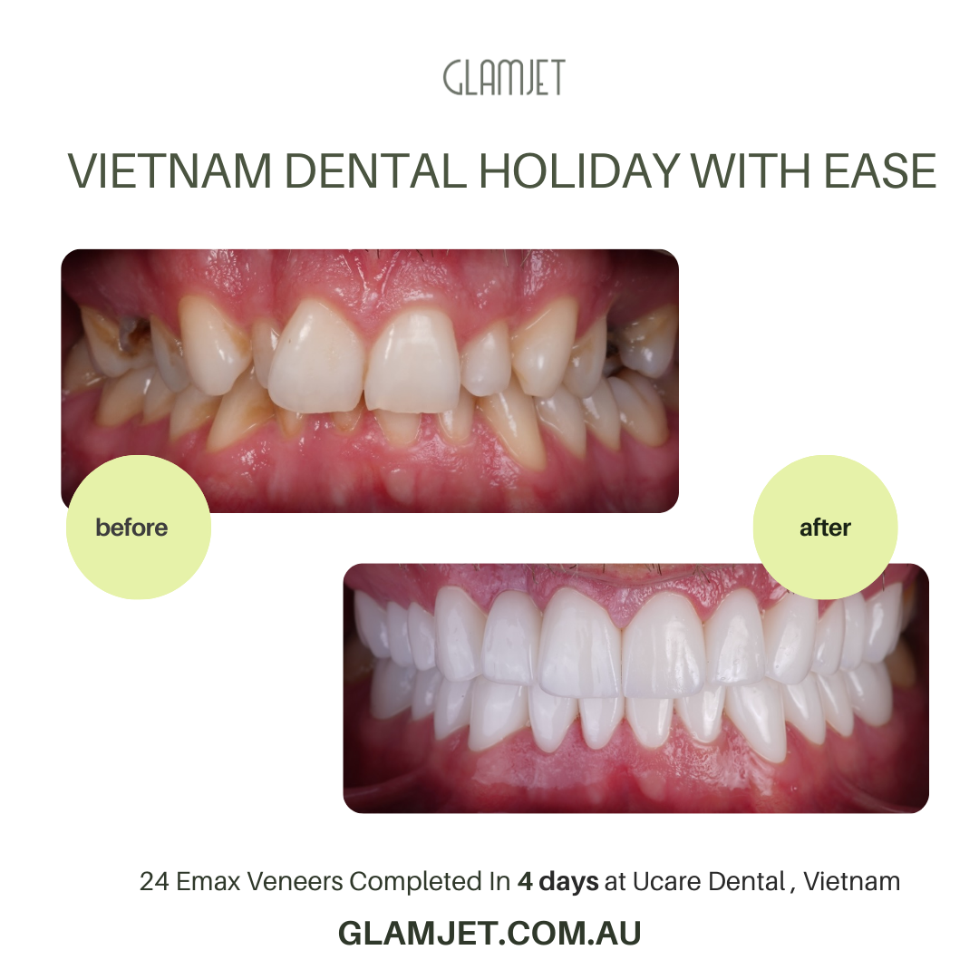 Transformative smile makeover with Emax Ceramic Veneers (no prep) at Ucare Dental Clinic, Ho Chi Minh, Vietnam. Vietnam dental tourism organized by Glamjet Dental Holiday, connecting clients from Australia, New Zealand, and the USA with expert veneer dentists in Vietnam.
