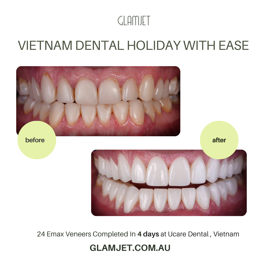 Experience the artistry of a smile makeover with Emax Ceramic Veneers at Win Smile Dental Clinic in Hanoi, Vietnam. Glamjet Dental Holiday connects you to top-tier dentists in Hanoi, Ho Chi Minh city, Vietnam and unforgettable travel adventures. Prices are affordable and 80% less than in Australia, the USA, and New Zealand. 