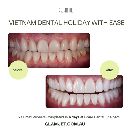 Experience the artistry of a smile makeover with Emax Ceramic Veneers at Win Smile Dental Clinic in Hanoi, Vietnam. Glamjet Dental Holiday connects you to top-tier dentists in Hanoi, Ho Chi Minh city, Vietnam and unforgettable travel adventures. Prices are affordable and 80% less than in Australia, the USA, and New Zealand. 