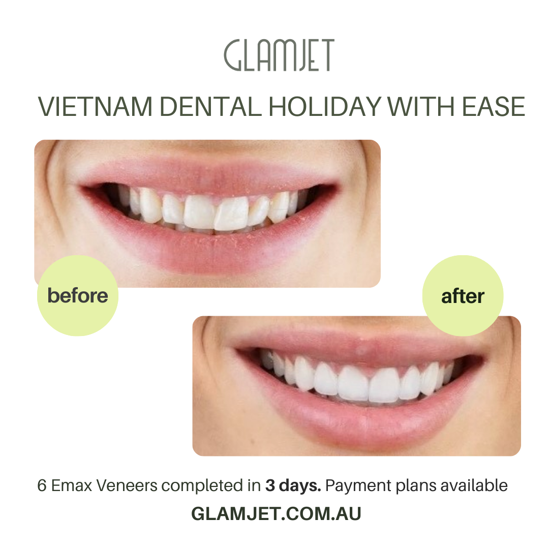Experience life-changing results with Emax Ceramic Veneers at Ucare Dental Clinic, Hanoi. Glamjet Dental Holiday simplifies dental tourism, offering access to Vietnam’s best dentists and vibrant travel destinations. No prep veneers and minimal preps veneers are available. The costs of ceramic veneers in Vietnam are much more affordable than prices in Australia, New Zealand, and the USA. 