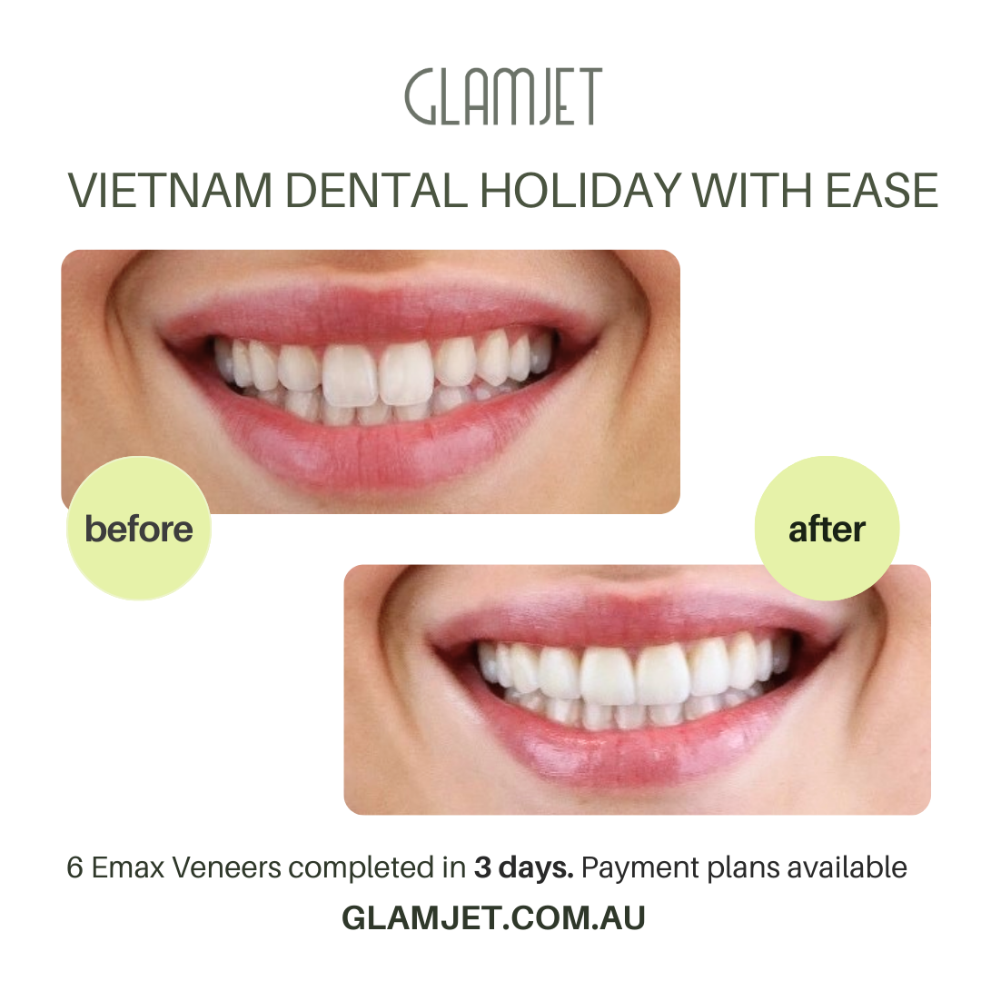 Emax Ceramic Veneers create a stunning smile makeover at Ucare Dental Clinic, Hanoi. Glamjet Dental Holiday connects international clients with affordable no-prep and minimal-prep veneer solutions in Vietnam, combined with memorable travel adventures. Glamjet works with the best dentists in Hanoi, Ho Chi Minh city, and Da Nang, Vietnam. 