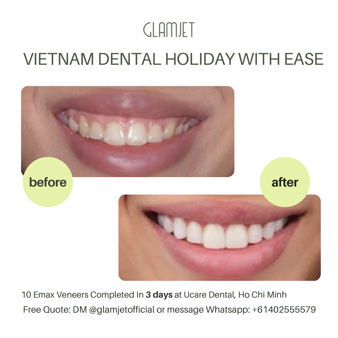 Emax Ceramic Veneers create a stunning smile makeover at Ucare Dental Clinic, Ho Chi Minh city, Vietnam. Glamjet Dental Holiday connects international clients with the top dentists in Hanoi and Ho Chi Minh City while ensuring a memorable journey through Vietnam's cultural and natural wonders. She also got a surgery to remove gummy smile. Emax veneers that she received are superior to porcelain veneers. 