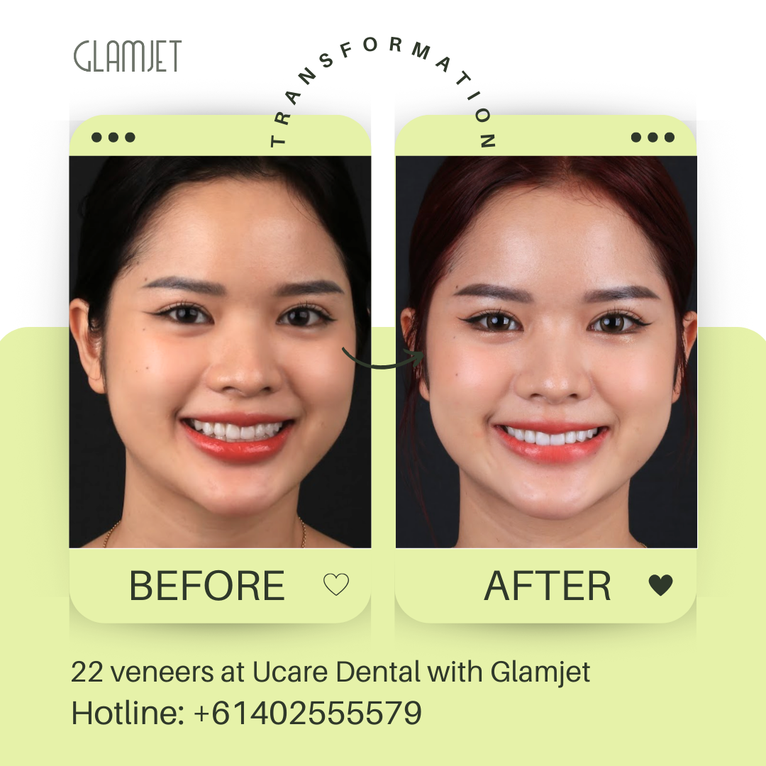 Smile makeover with Emax Ceramic Veneers (no prep) at Ucare Dental Clinic, Hanoi, Vietnam. Glamjet Dental Holiday offers superior dental tourism in Vietnam for clients from Australia, New Zealand, and the USA. Glamjet connect international clients with top English speaking dentists in Hanoi, Ho Chi Minh, and Da Nang. 
