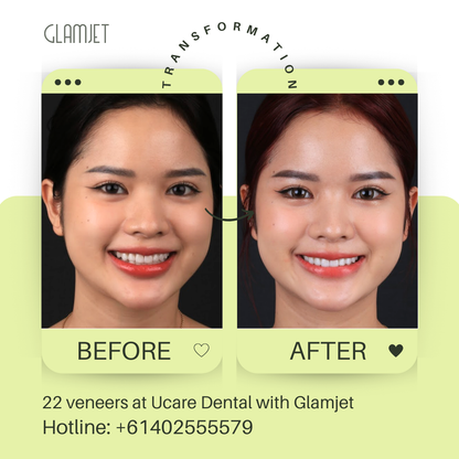 Smile makeover with Emax Ceramic Veneers (no prep) at Ucare Dental Clinic, Hanoi, Vietnam. Glamjet Dental Holiday offers superior dental tourism in Vietnam for clients from Australia, New Zealand, and the USA. Glamjet connect international clients with top English speaking dentists in Hanoi, Ho Chi Minh, and Da Nang. 
