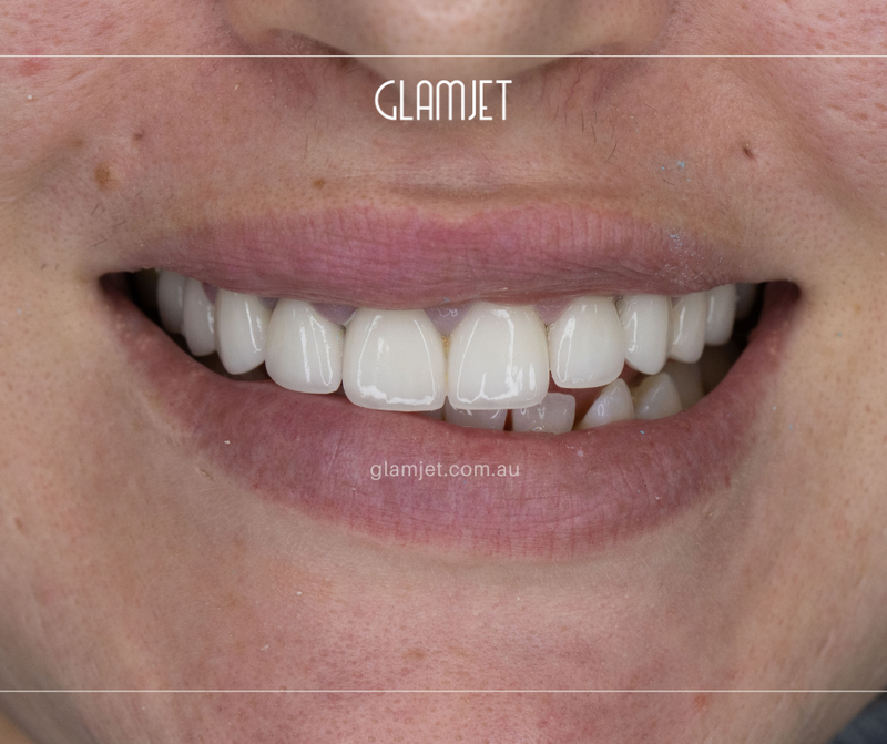 After - Case 1: Replace composite veneers with 10 Emax veneers