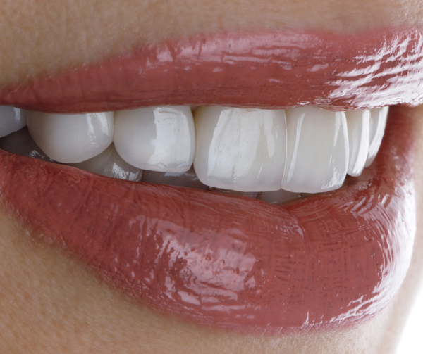 Emax veneers are more premium than traditional porcelain veneers