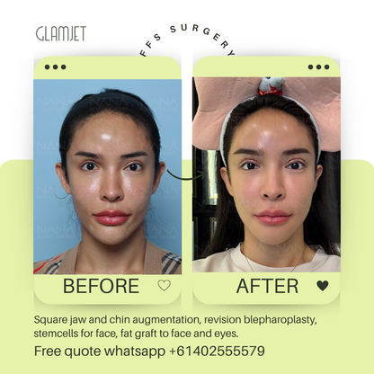 Before and after facial feminisation surgery in South Korea with glamjet.com.au at Nana plastic surgery hospital in South Korea jaw contouring rhinoplasty upper blepharoplasty, fat graft for eyes and face