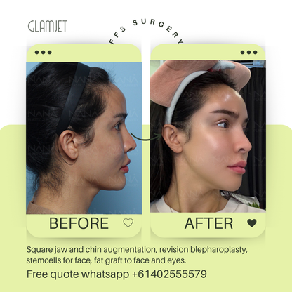 Before and after facial feminisation surgery in South Korea with glamjet.com.au at Nana plastic surgery hospital in South Korea jaw contouring rhinoplasty upper blepharoplasty, fat graft for eyes and face