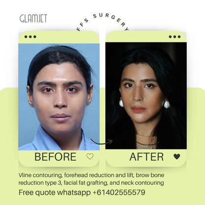 Before and after facial feminisation surgery in South Korea with glamjet.com.au at Nana plastic surgery hospital in South Korea jaw contouring rhinoplasty upper blepharoplasty, fat graft for eyes and face, forehead reduction, brow bone reduction type 3