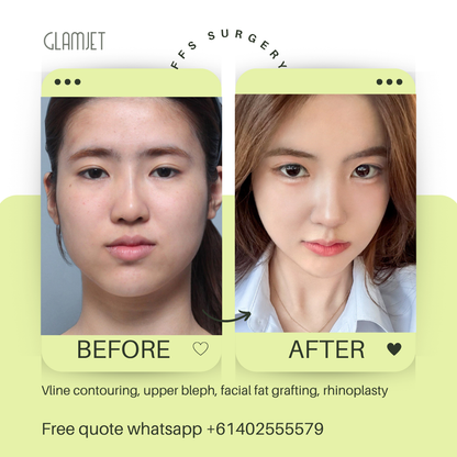 Before and after facial feminisation surgery in South Korea with glamjet.com.au at Nana plastic surgery hospital in South Korea jaw contouring rhinoplasty upper blepharoplasty, facial fat graft 