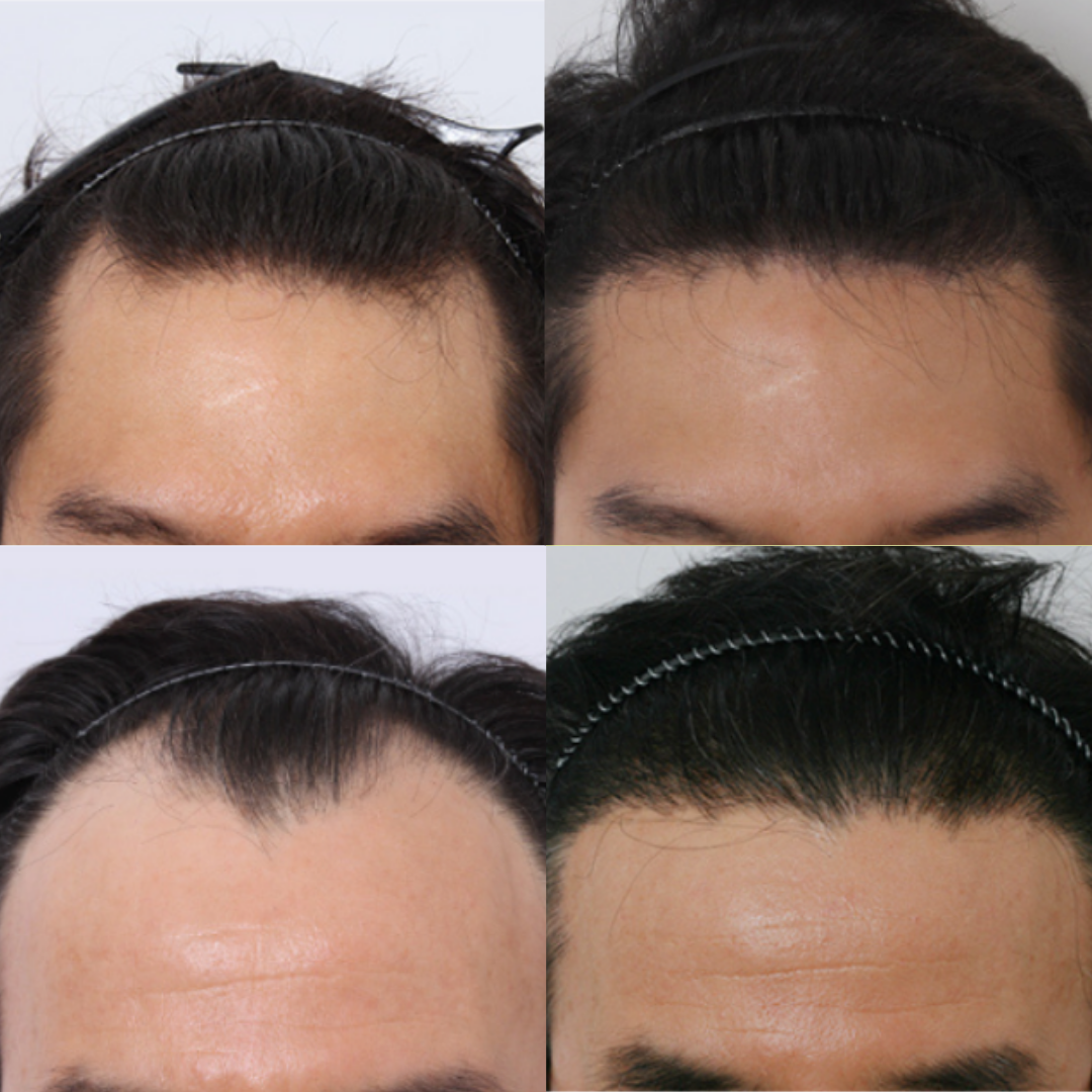 Hair Transplant Packages In South Korea