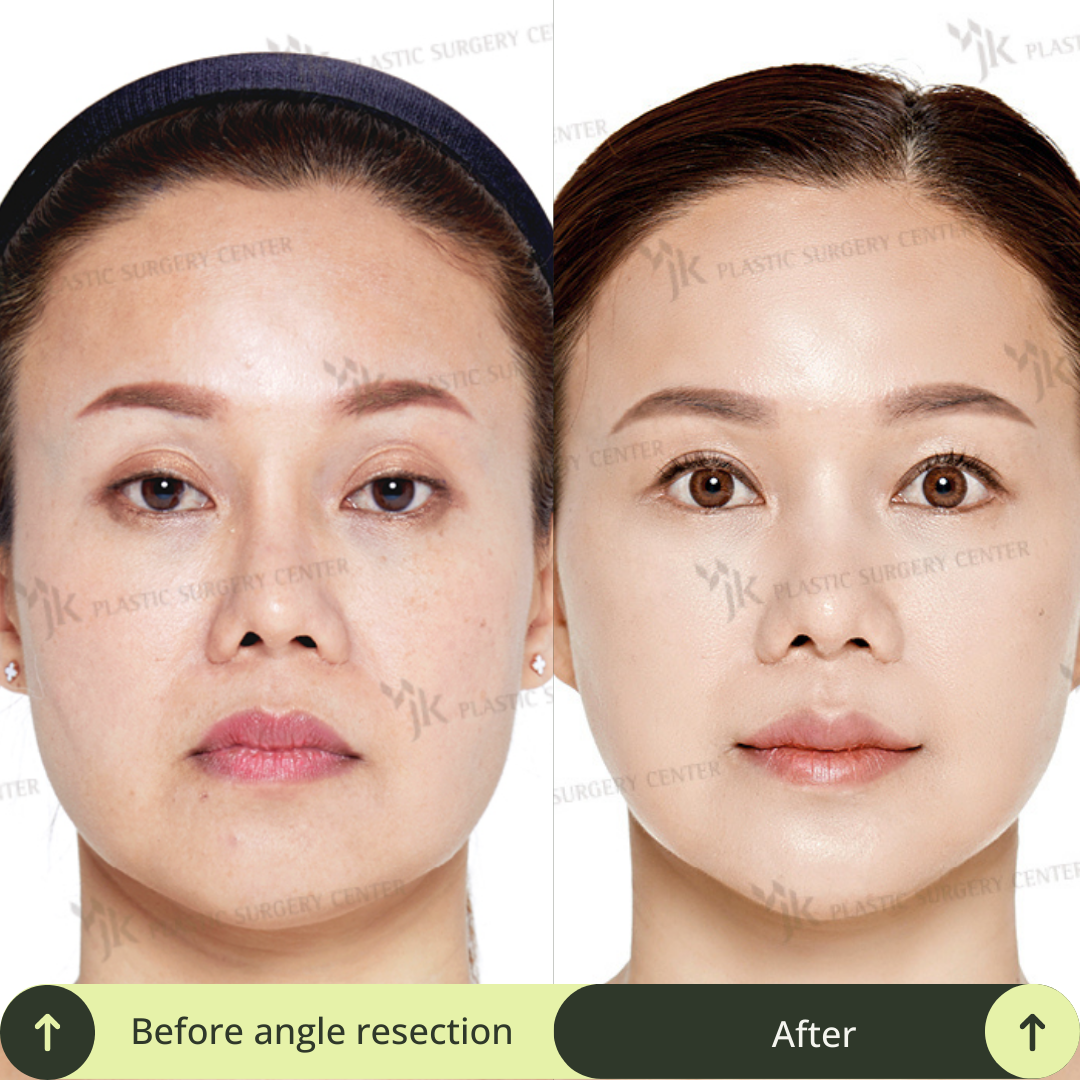 Women Face Contour Surgery Packages In South Korea