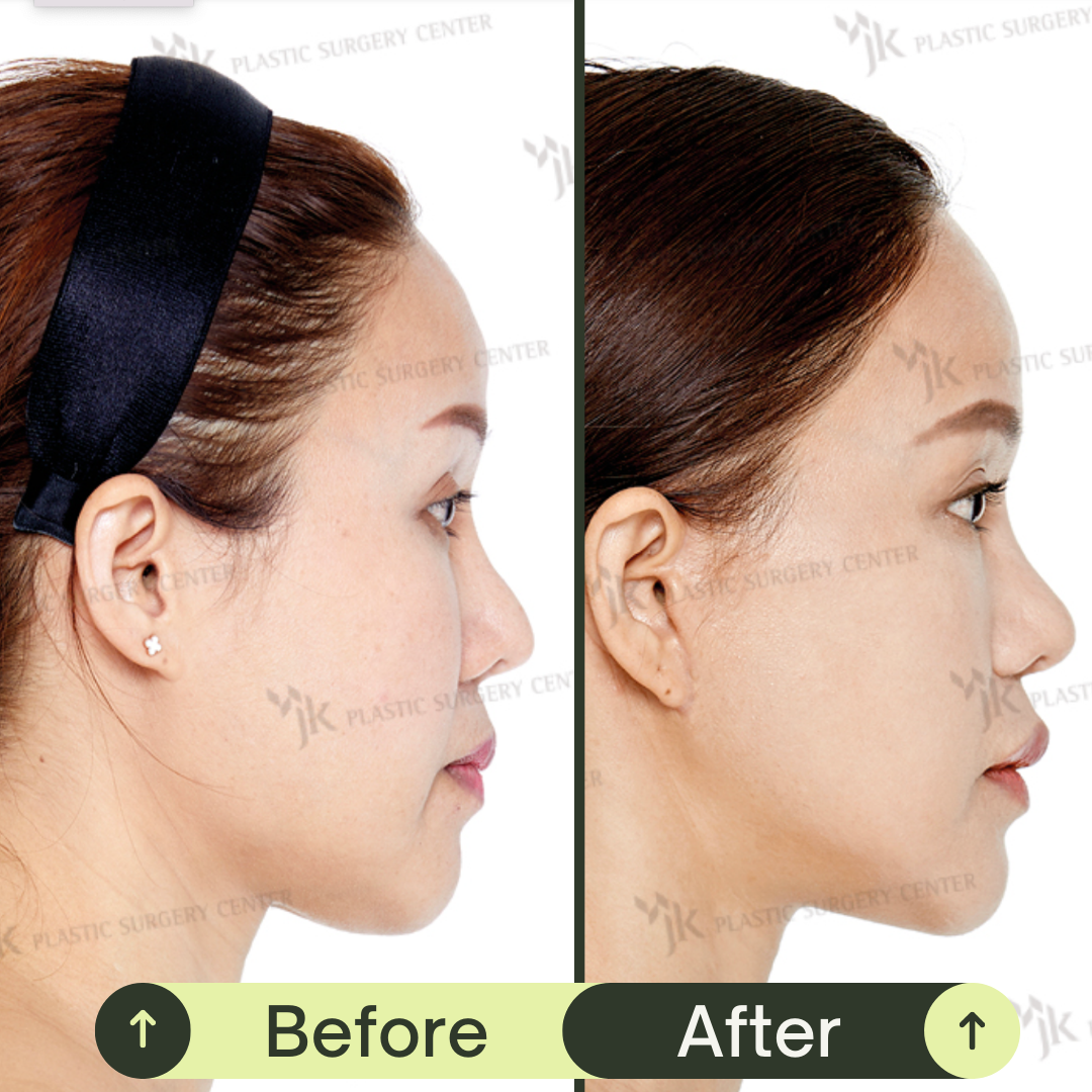 Women Face Contour Surgery Packages In South Korea