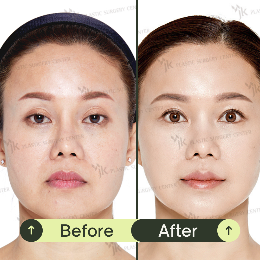 Fat Grafting For Face In South Korea