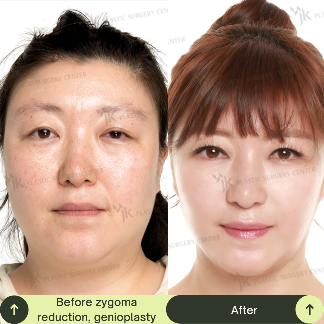 Cheek Bone Zygomatic Reduction Packages In South Korea