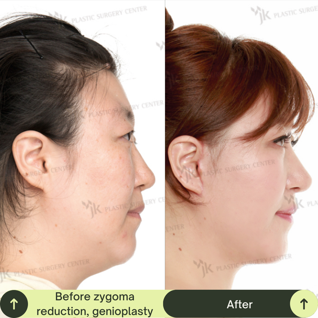 Cheek Bone Zygomatic Reduction Packages In South Korea