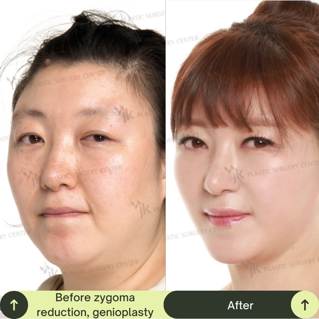 Women Face Contour Surgery Packages In South Korea