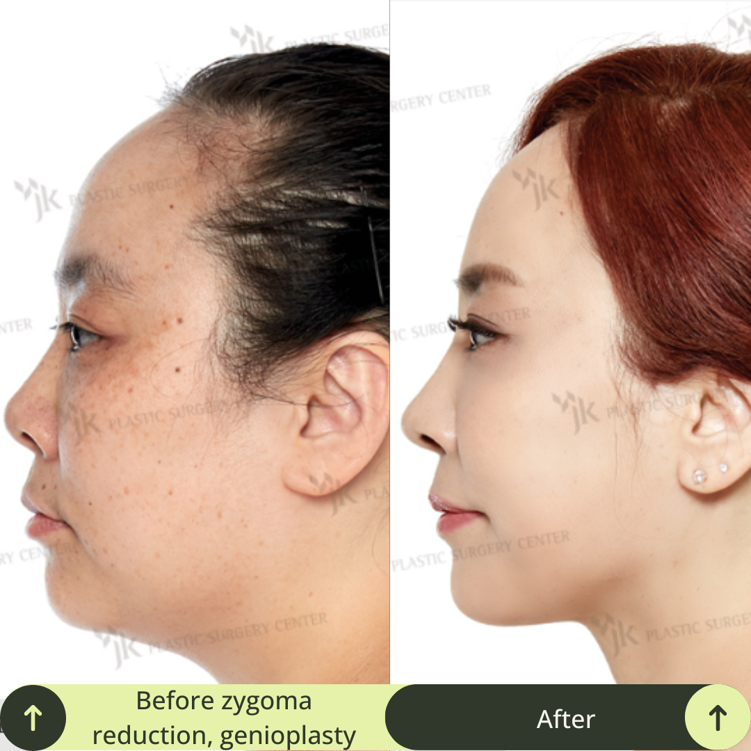 Women Face Contour Surgery Packages In South Korea