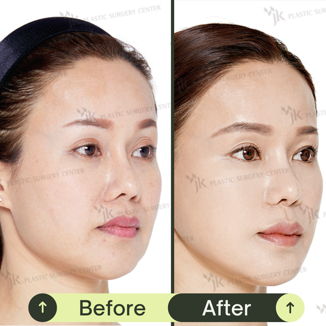 Fat Grafting For Face In South Korea