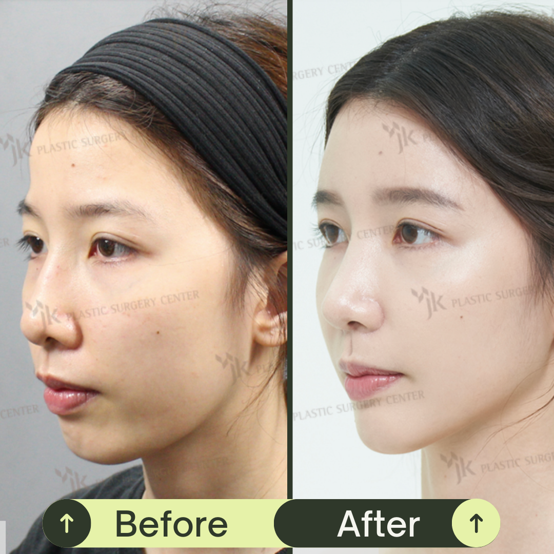 Fat Grafting For Face In South Korea