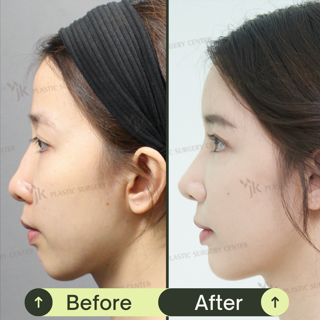 Fat Grafting For Face In South Korea