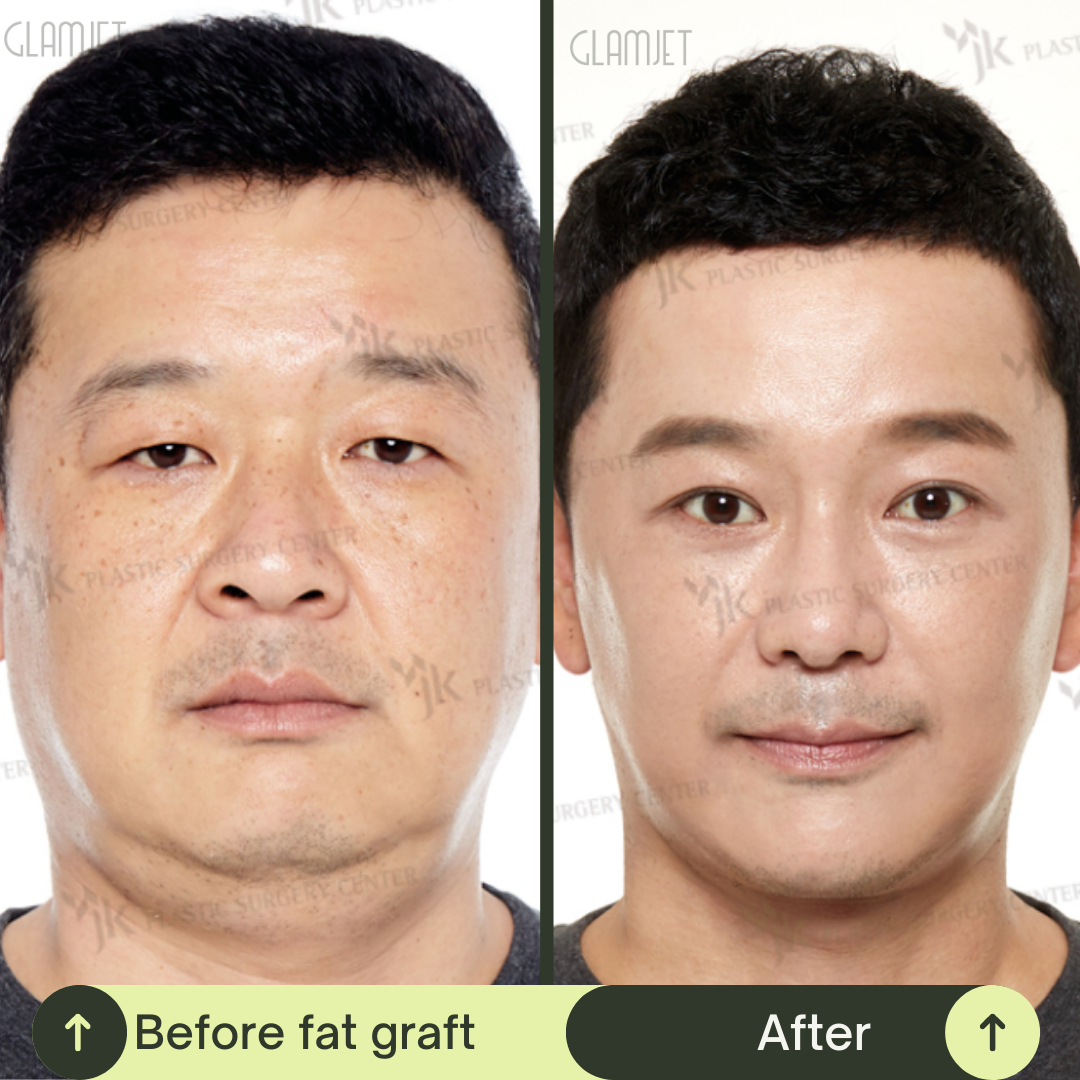 Men Face Lift Packages in South Korea