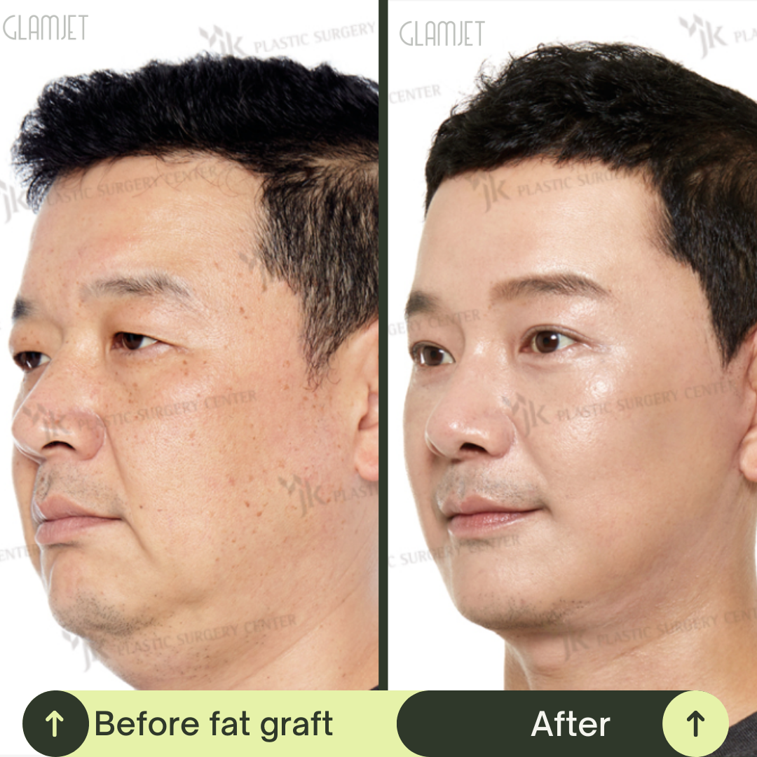 Men Face Lift Packages in South Korea