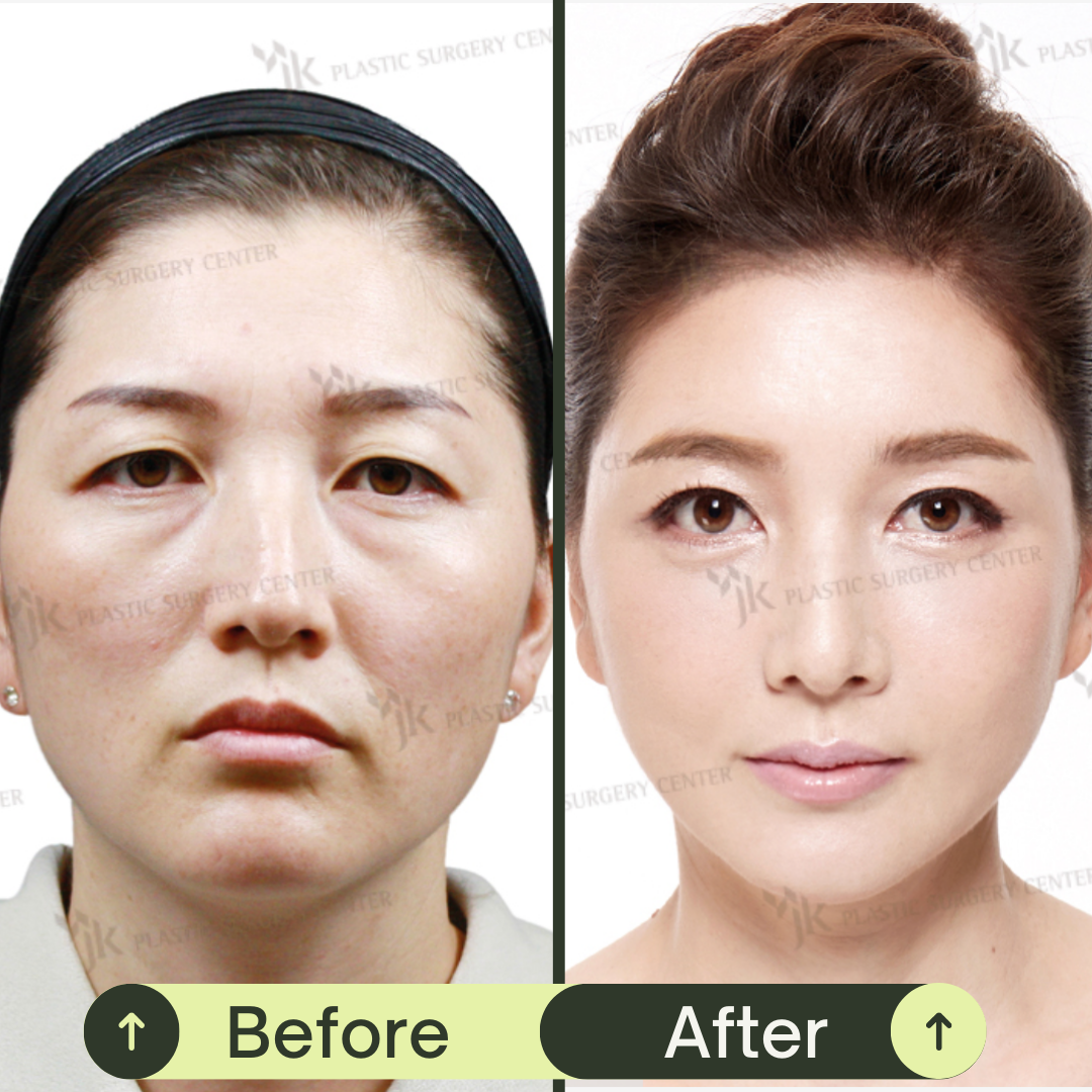 Fat Grafting For Face In South Korea