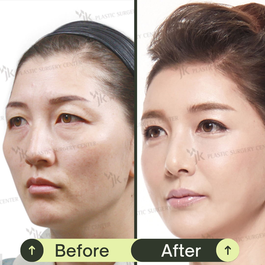 Fat Grafting For Face In South Korea