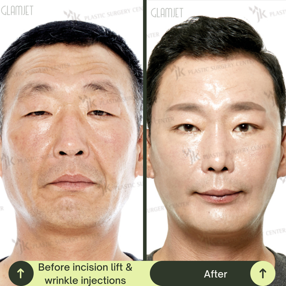 Men Face Lift Packages in South Korea