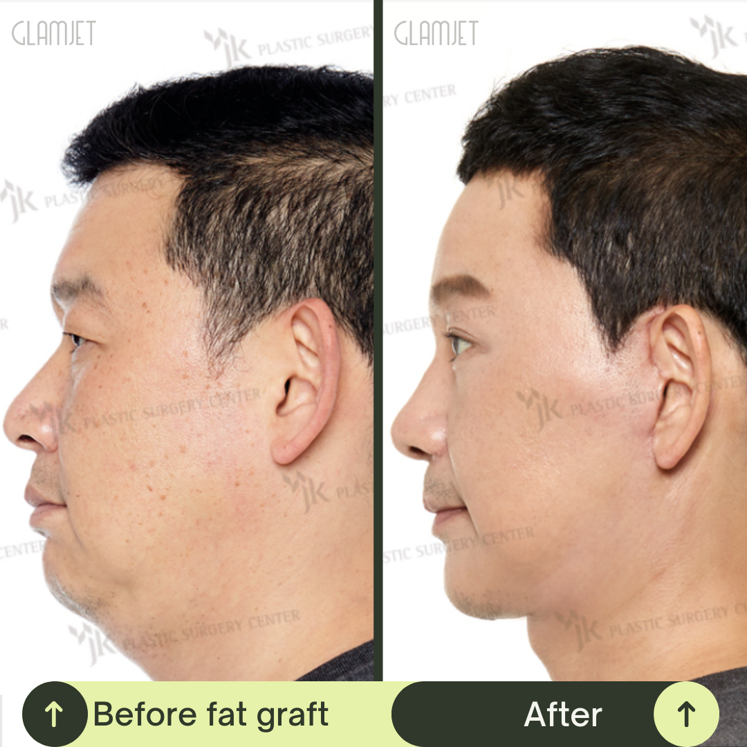 Men Face Lift Packages in South Korea