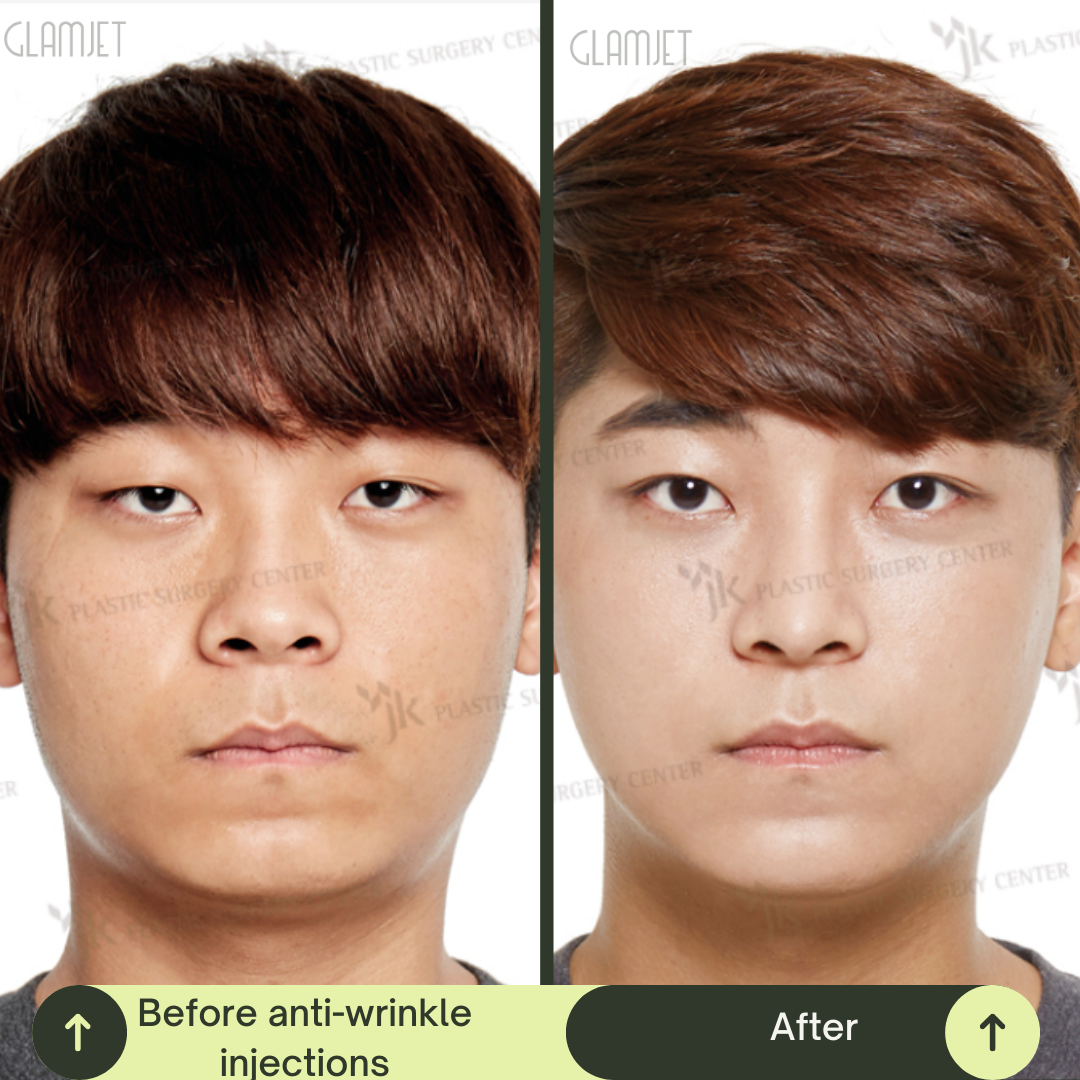 Men Face Lift Packages in South Korea