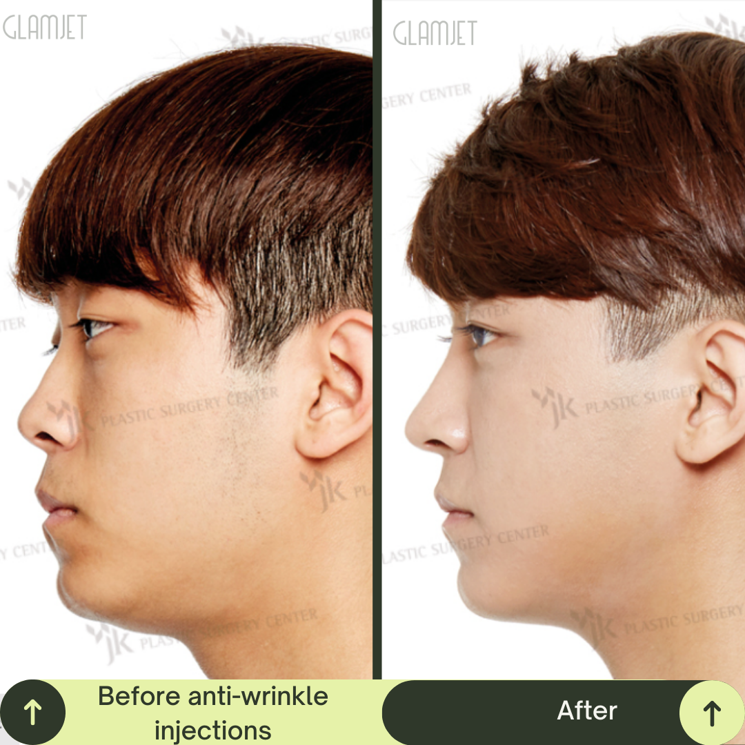 Men Face Lift Packages in South Korea