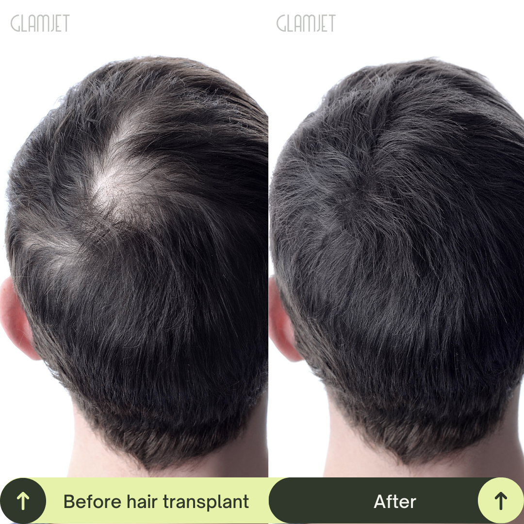 Hair Transplant Packages In South Korea