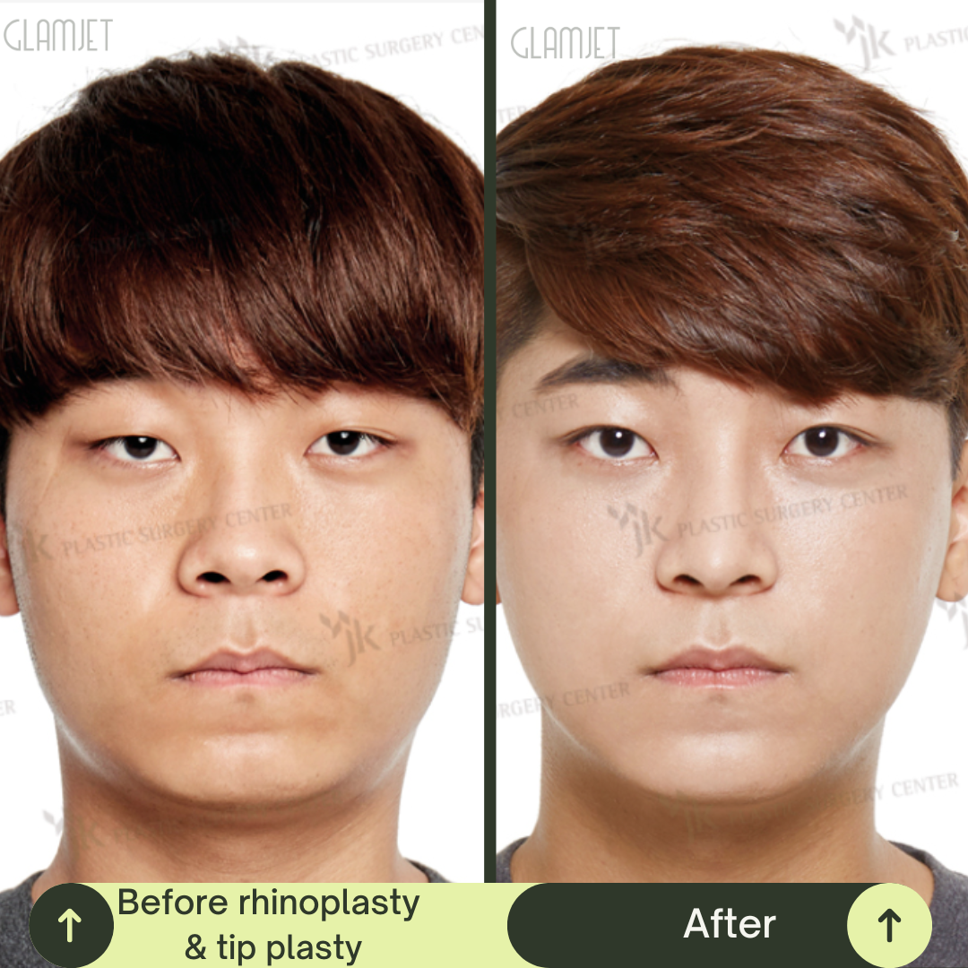 Men Rhinoplasty Surgery Packages In South Korea