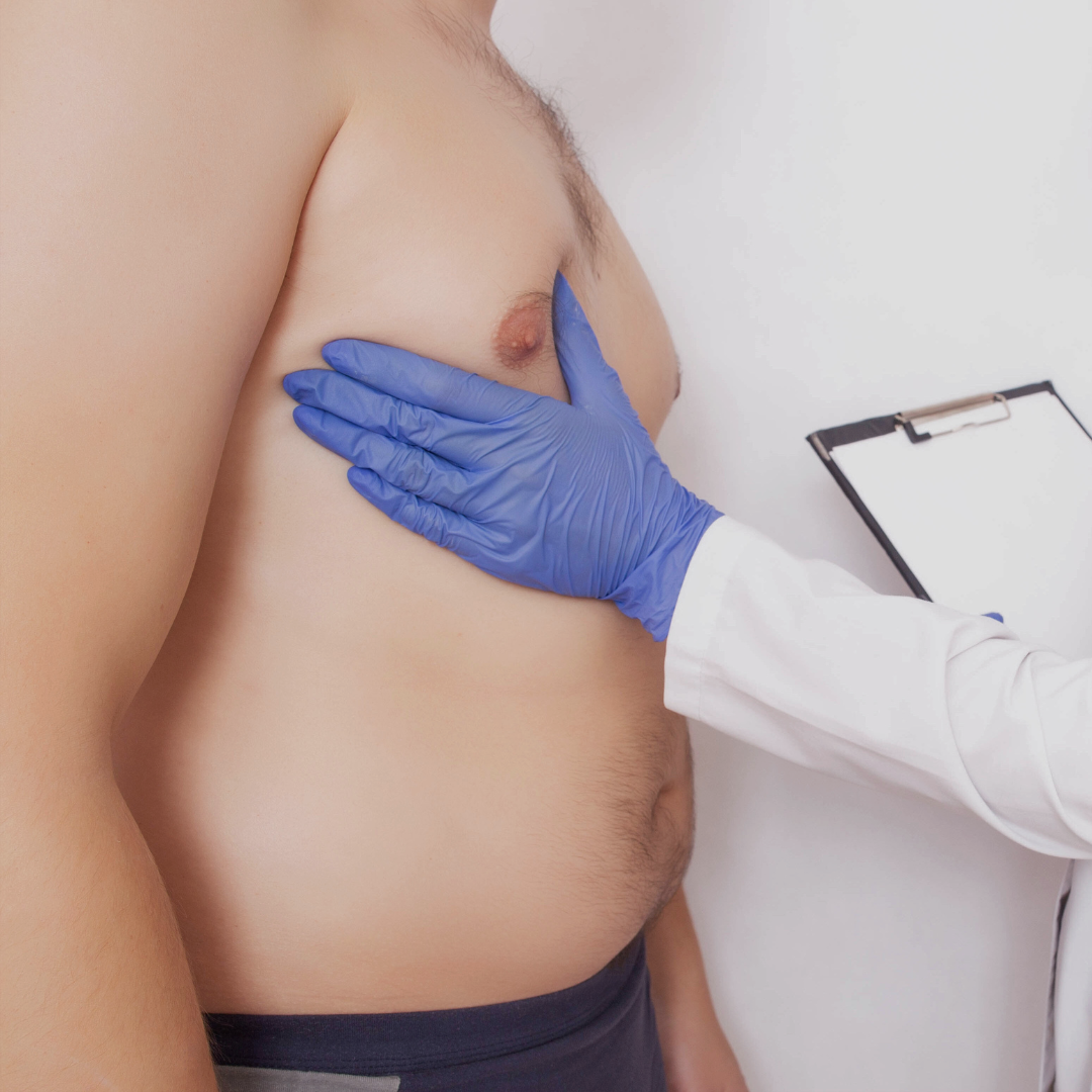 Men Gynaecomastia (Breast Surgery) Packages In South Korea