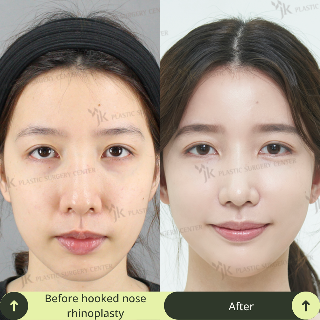 Women Rhinoplasty Surgery Packages In South Korea