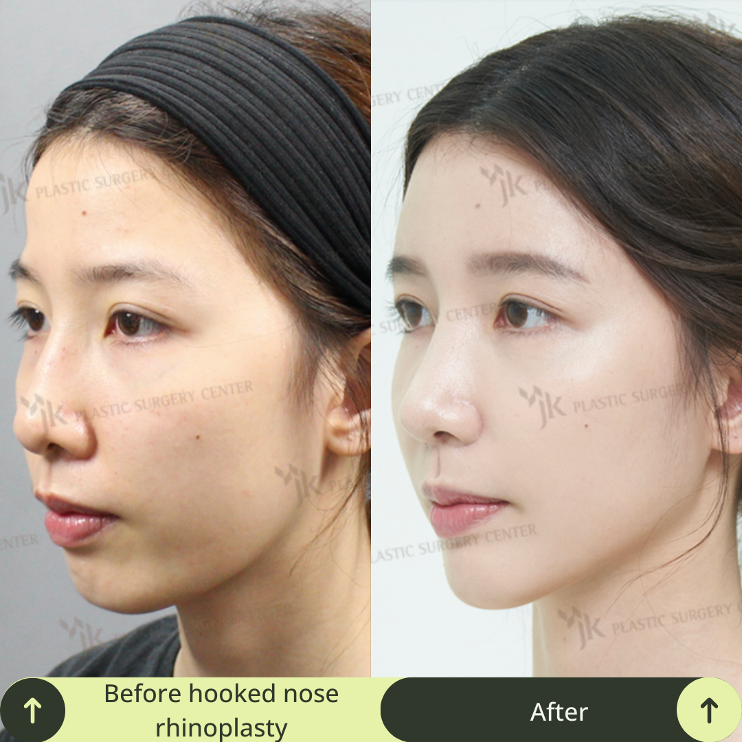 Women Rhinoplasty Surgery Packages In South Korea