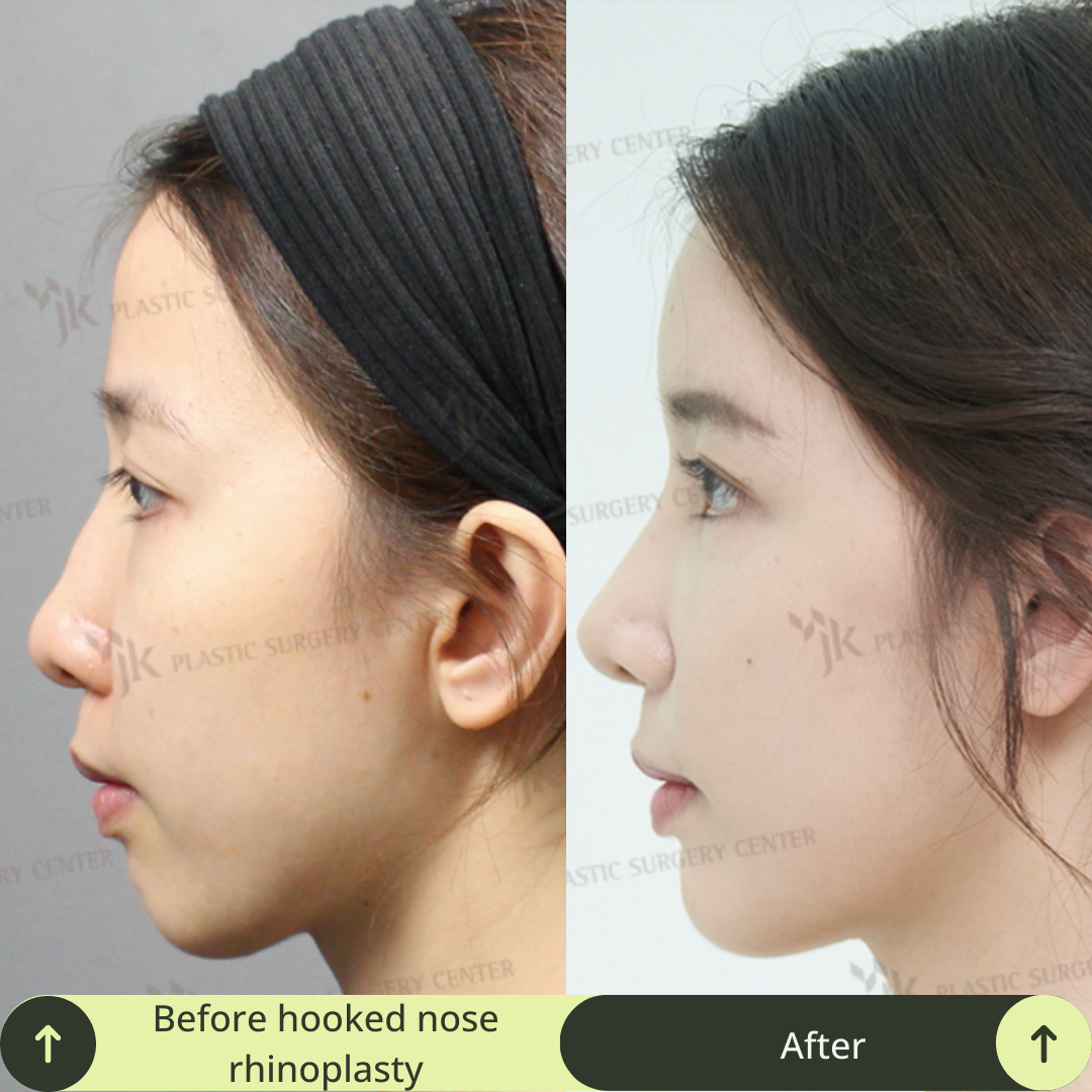 Women Rhinoplasty Surgery Packages In South Korea