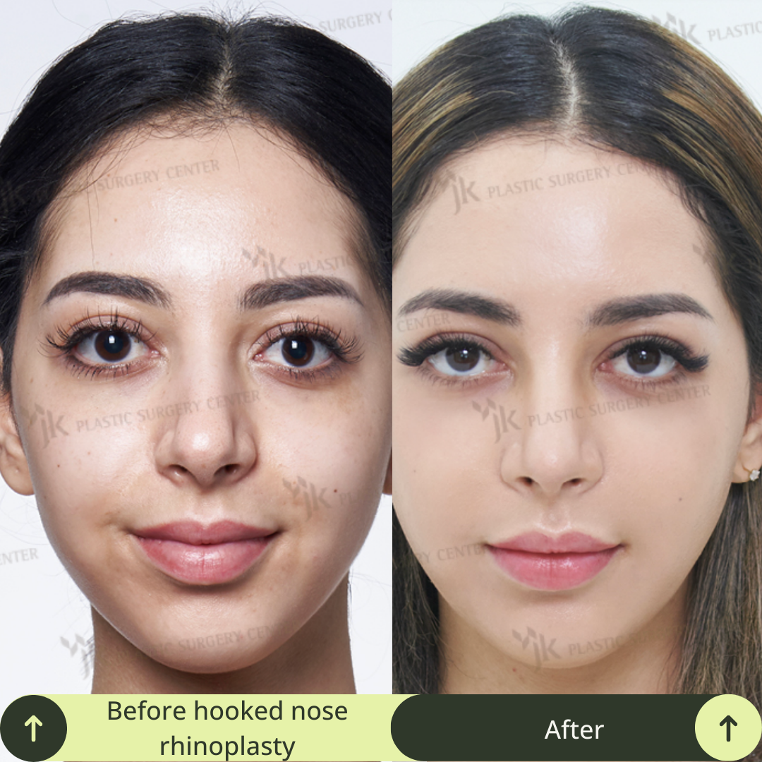 Women Rhinoplasty Surgery Packages In South Korea