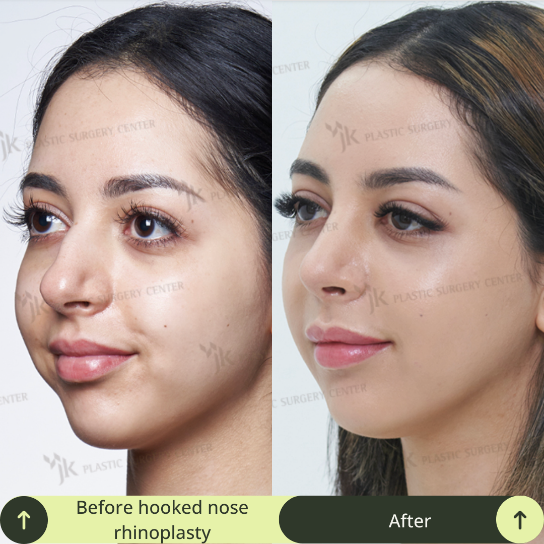 Women Rhinoplasty Surgery Packages In South Korea