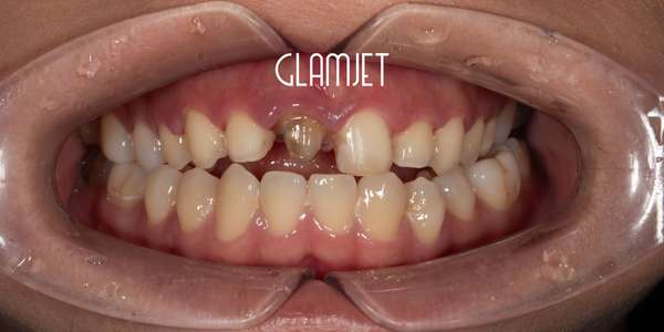 E-max Veneer