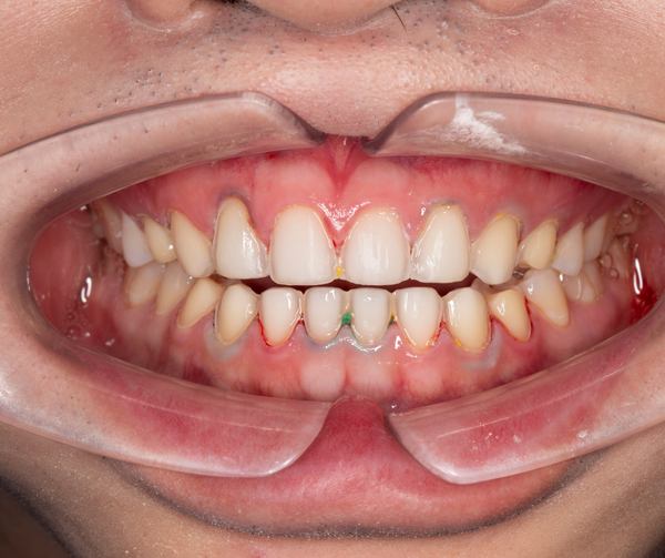How much will my teeth be shaved?