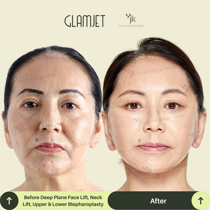 Before and after neck lift surgery results for an Australian woman in her 50s who travelled to Seoul, South Korea for SMAS facelift and neck lift with Glamjet.com.au’s medical concierge service. Visible improvements in jawline definition and loose skin reduction.