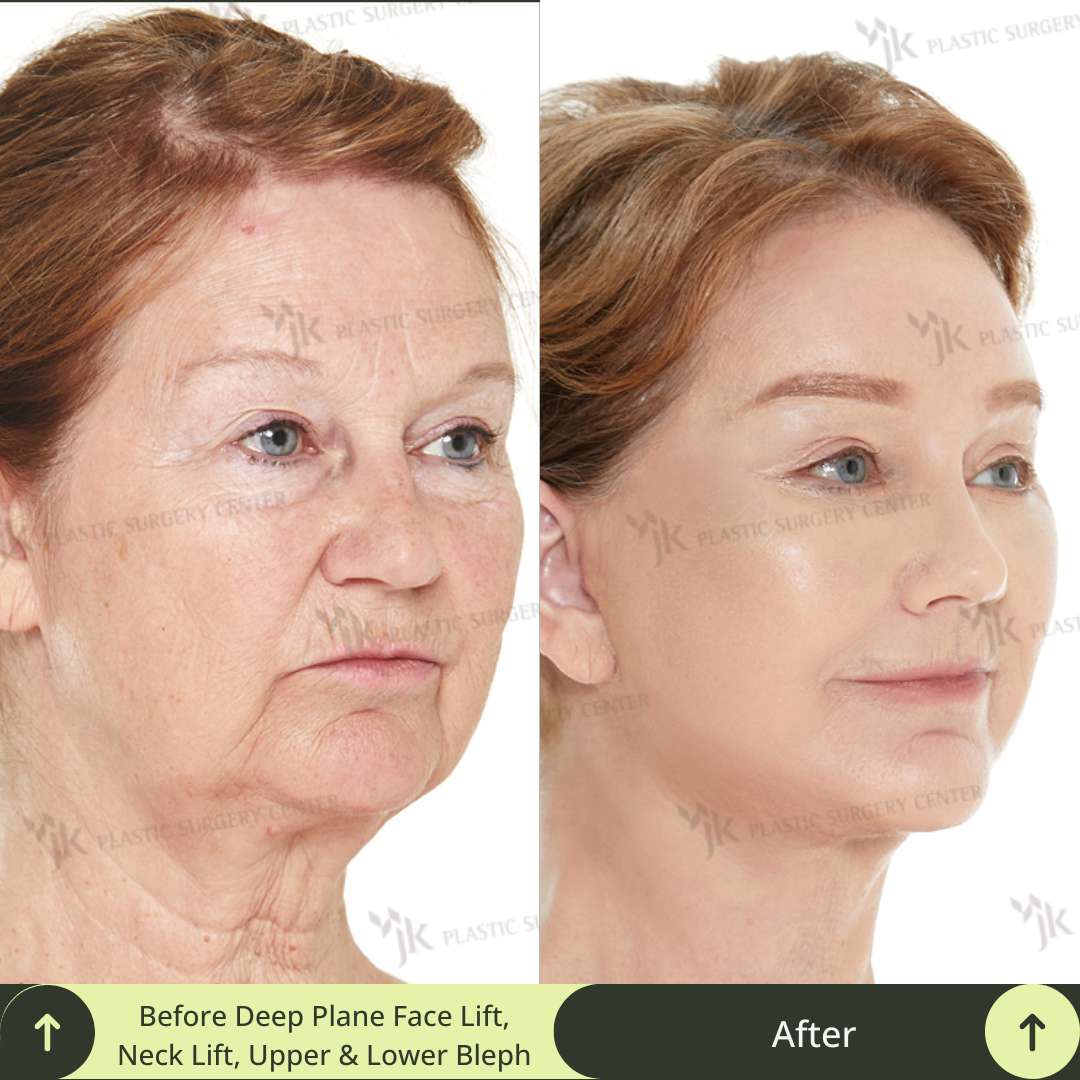 The image captures the remarkable results of a middle-aged woman’s aesthetic journey, featuring a deep plane SMAS facelift, neck lift, upper blepharoplasty and lower blepharoplasty, and advanced CO2 laser skin treatment. Glamjet, a leading beauty concierge service, connects clients from Australia, the USA, and beyond with South Korea’s most skilled specialist board certified plastic surgeons, avoiding factory clinics and ensuring optimal results. 