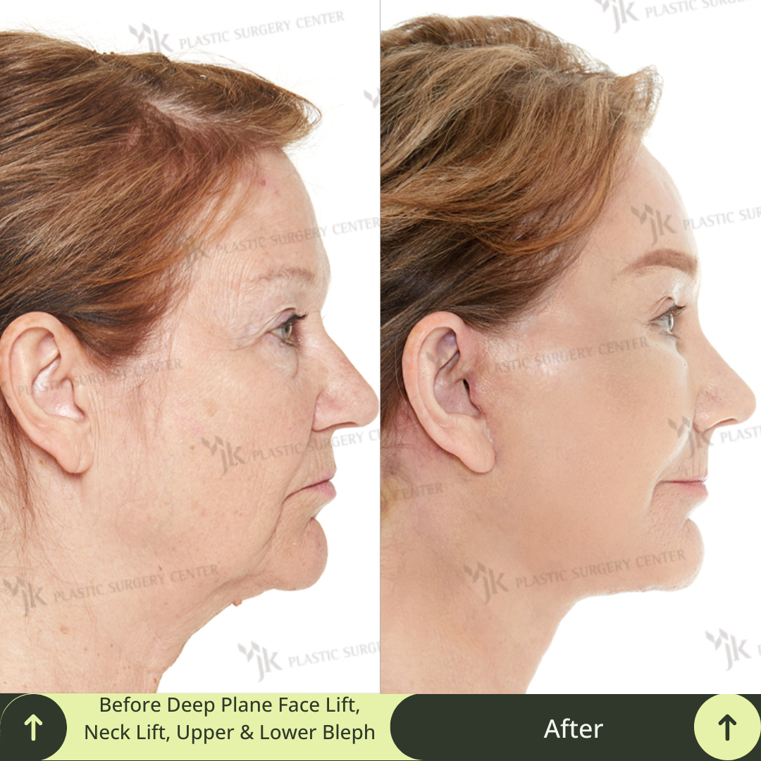 Witness the power of premium plastic surgery transformation in this before-and-after photo, showcasing a deep plane SMAS facelift, neck lift, rhinoplasty, upper blepharoplasty, lower blepharoplasty, and skin rejuvenation with CO2 laser therapy. Glamjet provides trusted beauty medical concierge services to clients from Canada, New Zealand, and other regions, partnering exclusively with South Korea’s most reputable board-certified surgeons.