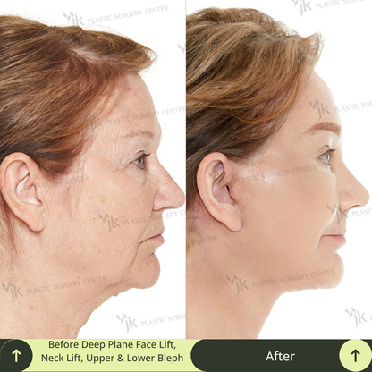 Witness the power of premium plastic surgery transformation in this before-and-after photo, showcasing a deep plane SMAS facelift, neck lift, rhinoplasty, upper blepharoplasty, lower blepharoplasty, and skin rejuvenation with CO2 laser therapy. Glamjet provides trusted beauty medical concierge services to clients from Canada, New Zealand, and other regions, partnering exclusively with South Korea’s most reputable board-certified surgeons.