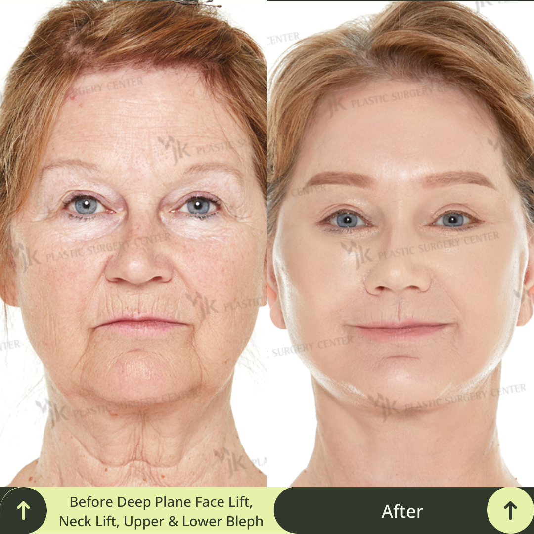 This compelling before-and-after transformation highlights the results of a deep plane SMAS facelift, neck lift, Upper and Lower Blepharoplasty, and skin laser treatments performed by top specialist board-certified surgeons and dermatologist in Gangnam, Seoul. Glamjet specializes in beauty medical concierge services, guiding clients from Australia, New Zealand, Canada, and the USA to achieve their dream look in South Korea and offer packages with payment plans. 